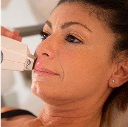 Epilazione laser a diodo